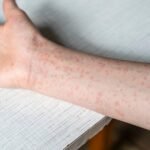 Measles cases in the U.S. hit 1,288, the highest recorded in more than 30 years
